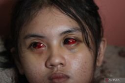 Polri pastikan beri perawatan maksimal korban tragedi Kanjuruhan